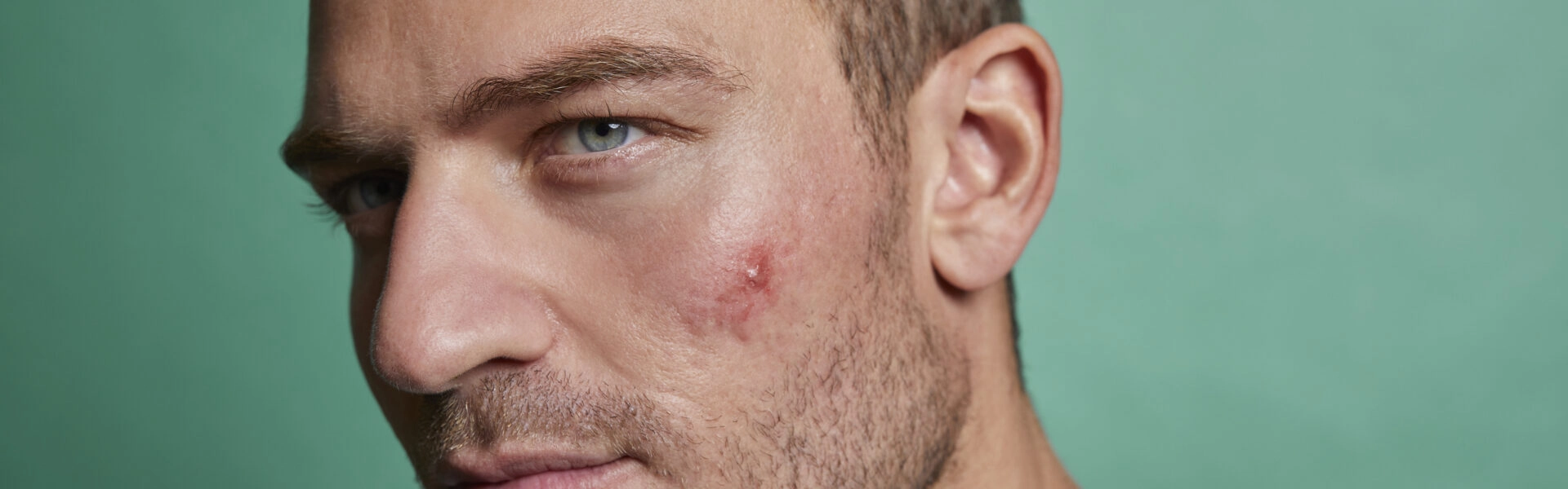 Peaux à tendance acnéique