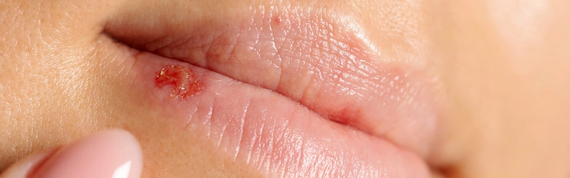 Peaux sujettes à l’herpès labial